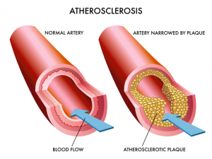 atherosclerosis