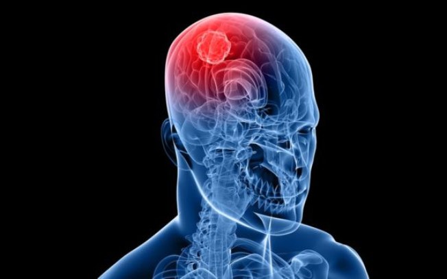 Droga mostrou-se 10 vezes mais potente que as existentes no tratamento de tumores cerebrais