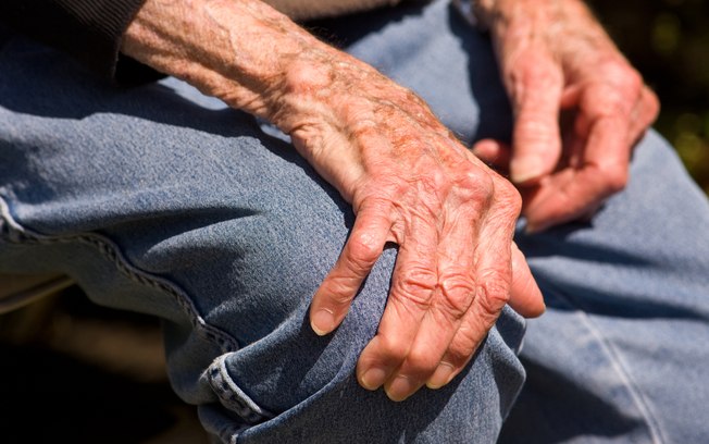 Artrite é uma doença sem cura, mas que pode ser controlada com o uso de medicamentos e melhorada com o diagnóstico precoce