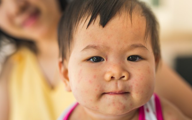 Vacinação contra sarampo deve ser feita em todas as crianças de um ano e menores de cinco anos