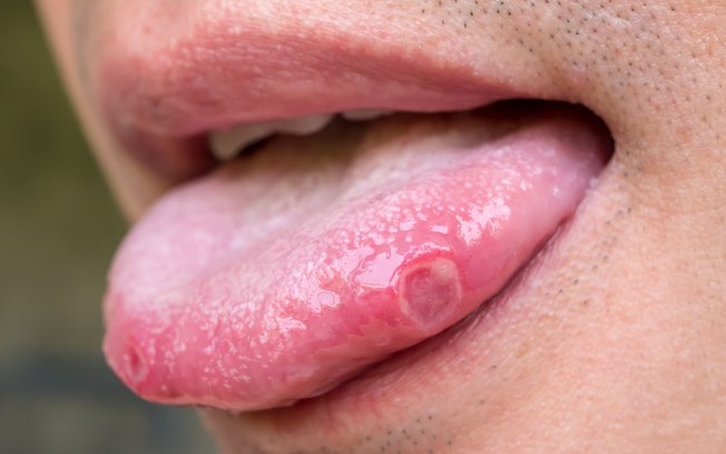 A língua pode revelar sinais de doenças como gastrite, diabetes e anemia